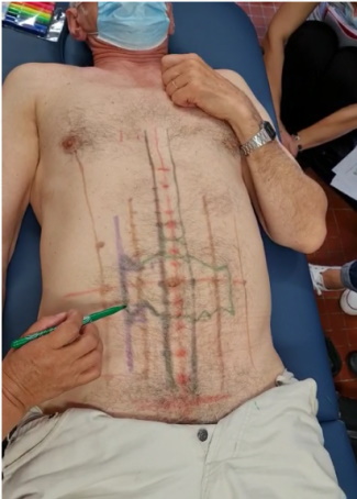 acupuncture abdominale