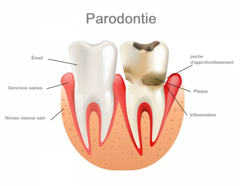 Le traitement de la parodontite en MTC – Dr Frank Ponsaty